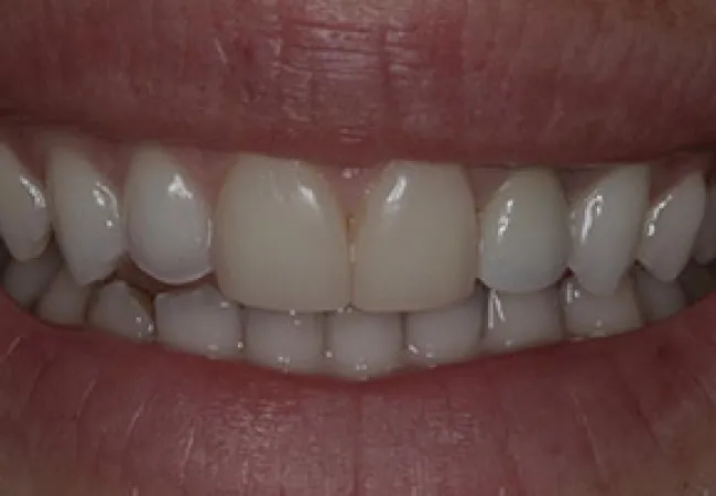 Close-up of a smile showing clean, healthy teeth and natural lips with slight gloss.