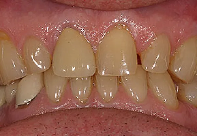 Close-up of adult teeth with yellowing, crowding, and dental misalignment in upper and lower jaws.