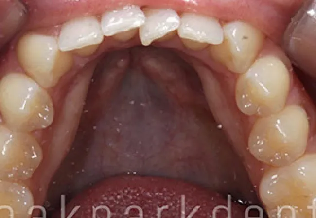Close-up of upper teeth and gums showing dental condition and oral cavity details.