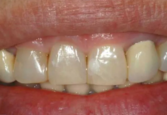 Close-up of a smile showing slightly yellowed upper front teeth with mild spacing and gum line visible.