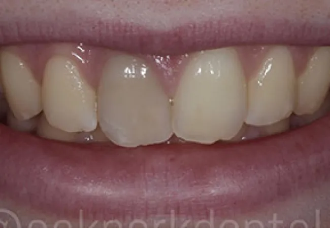 Close-up of a smile showing natural teeth with slight discoloration and uneven edges.