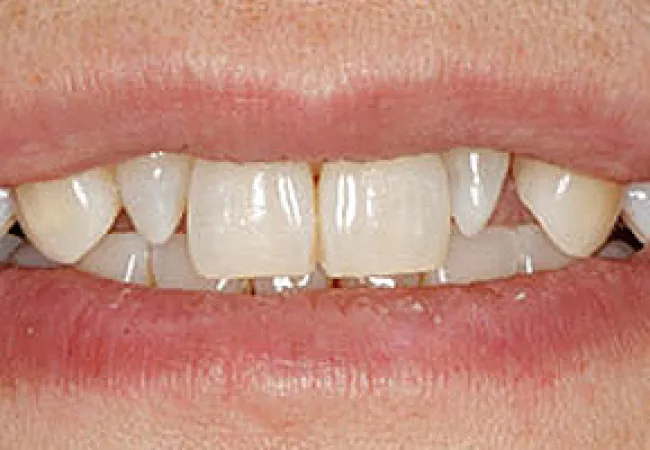 Close-up of human smile showing teeth with visible gaps and slight discoloration on some teeth.