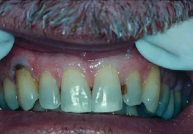 Close-up of adult mouth with decayed and discolored upper front teeth showing dental issues.