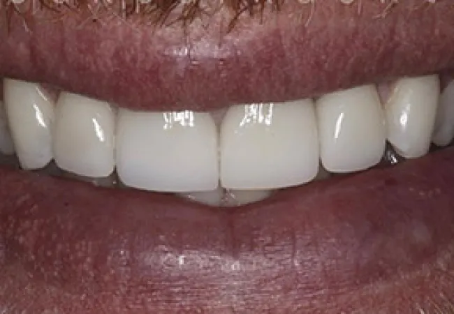 Close-up of a smiling mouth showing white teeth and slightly dry lips.