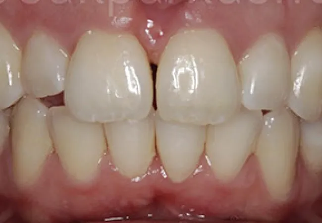 Close-up of upper and lower teeth showing slight misalignment and spacing between front teeth.