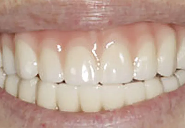 Close-up of a bright, healthy smile showing clean white teeth and natural gums.
