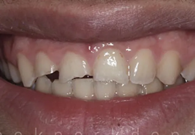 Close-up of a mouth with chipped and uneven front teeth showing dental damage.
