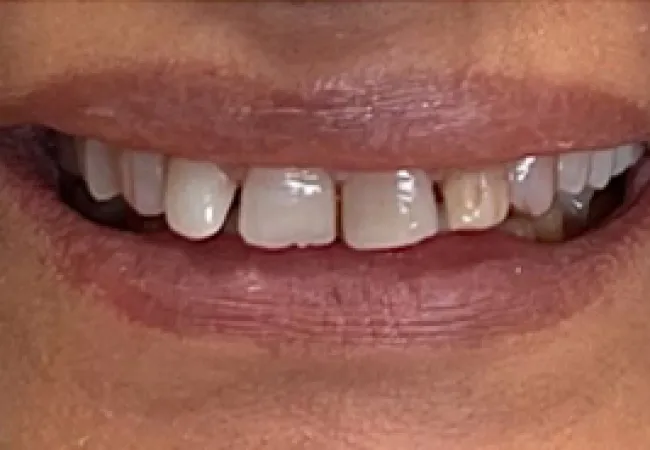 Close-up of a person's mouth showing uneven and discolored teeth with some gaps.