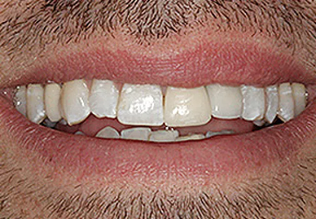 Close-up of a man's mouth showing lips, teeth with discoloration and dental irregularities.