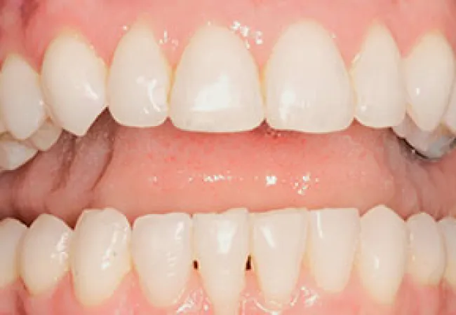 Close-up of upper and lower teeth showing dental alignment and natural enamel texture in a smiling mouth.