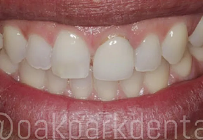 Close-up of a smile showing upper teeth with dental discoloration and staining on front teeth.