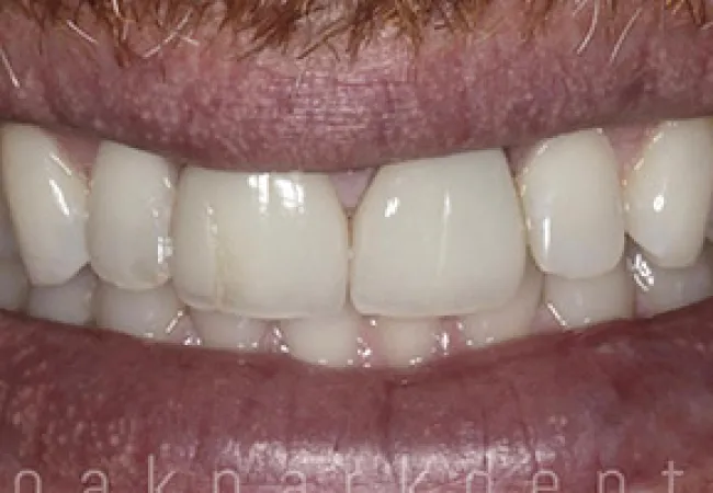 Close-up of a smile showing healthy, clean teeth and natural lips with a neutral background.