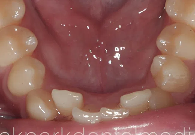 Close-up of lower teeth with severe dental damage and broken front teeth inside the mouth.