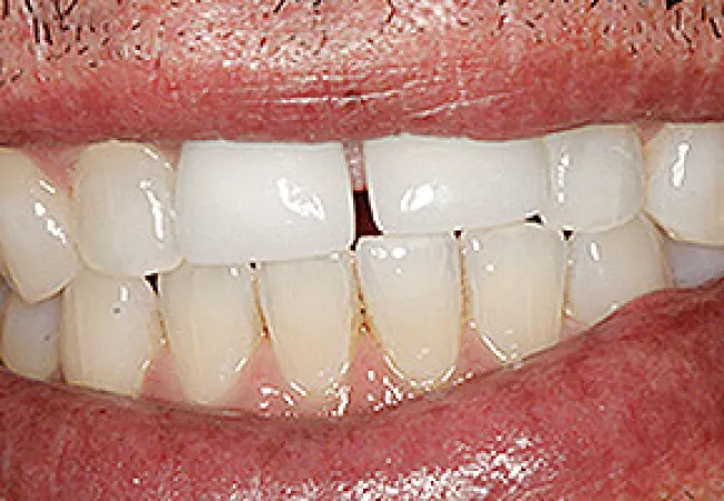 Close-up of a smiling mouth showing teeth with a noticeable white dental crown among natural teeth.