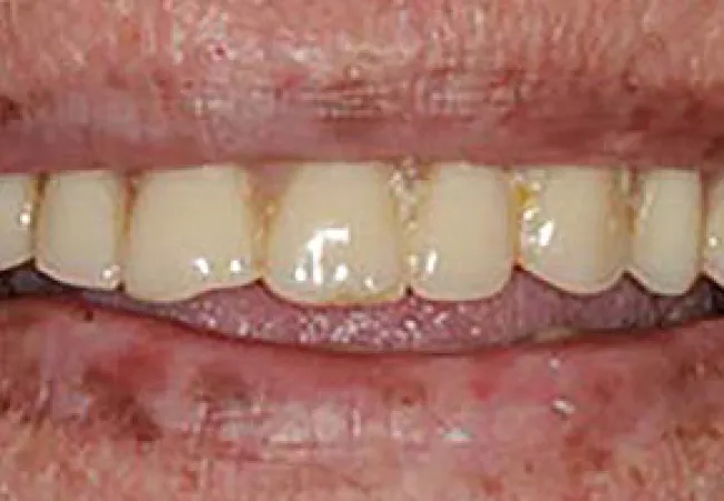 Close-up of a person's mouth showing stained and unevenly colored teeth with dry, cracked lips