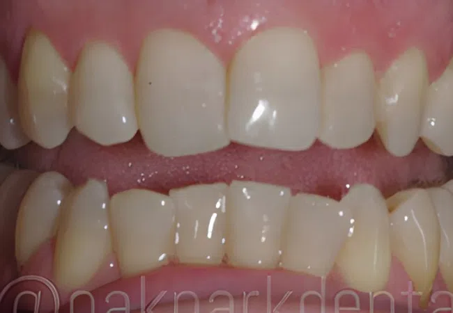 Close-up of upper and lower teeth showing dental wear and discoloration on some teeth.