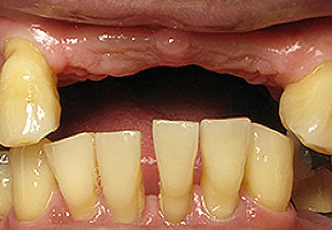 Close-up of a mouth with severely misaligned, discolored, and damaged teeth showing dental issues.