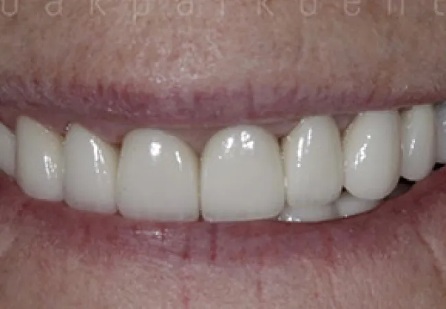Close-up of a smile showing clean, white, evenly aligned artificial dental veneers.