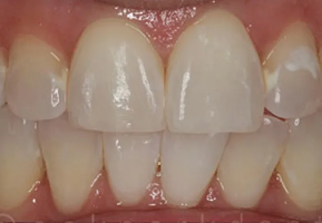 Close-up of human teeth with white spots and enamel irregularities on front teeth.