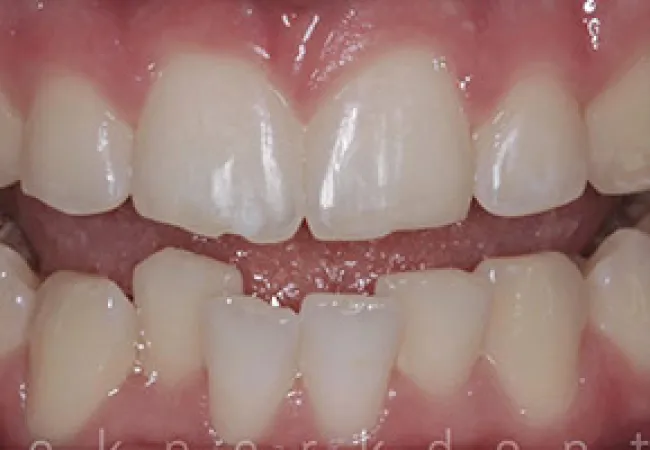 Close-up of misaligned human teeth showing gaps and irregular spacing between upper and lower front teeth.