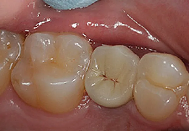 Close-up of healthy molars and premolars showing chewing surfaces and gums inside a human mouth.