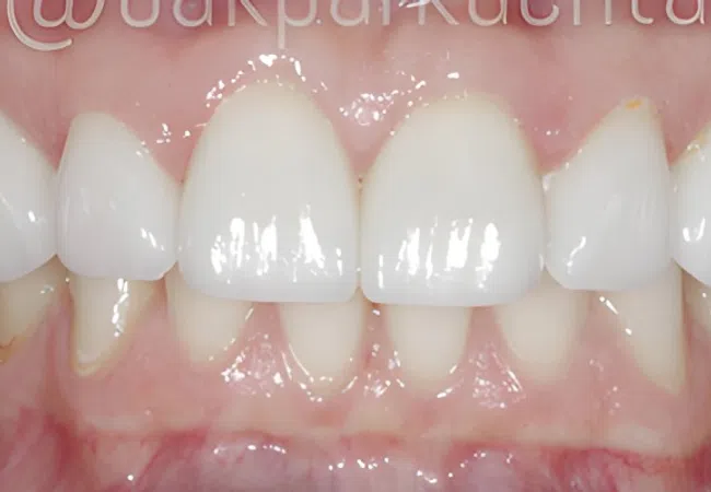Close-up of healthy upper and lower teeth showing clean white front teeth and pink gums.