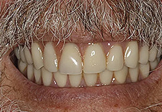 Close-up of a smiling elderly man showing natural teeth and a gray mustache