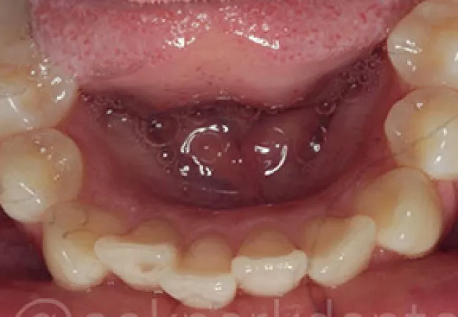 Close-up of lower teeth showing dental crowding and overlapping incisors in the mouth.
