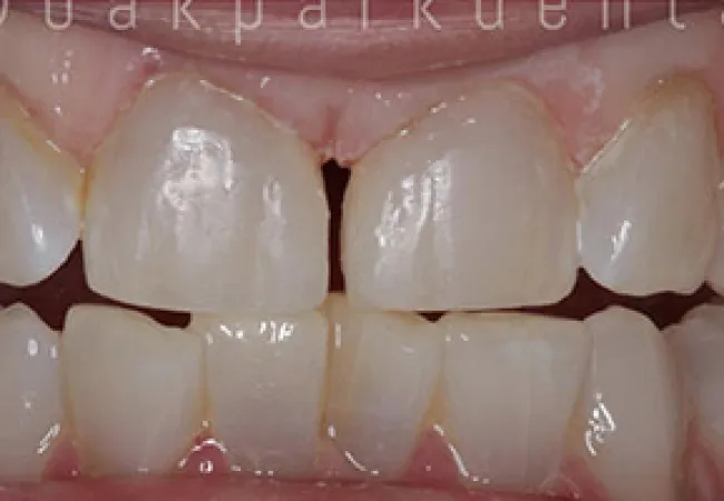 Close-up of human teeth showing a gap between the front upper teeth and slight discoloration.