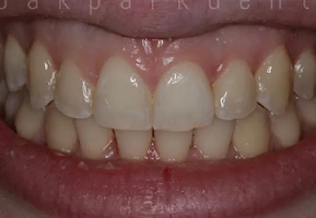 Close-up of a smile showing slightly yellow, unevenly spaced teeth and healthy pink gums.