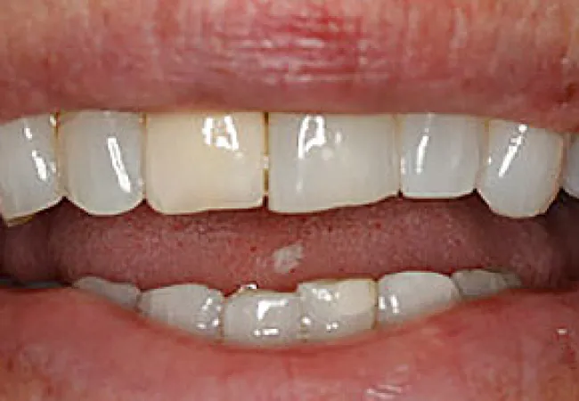 Close-up of a mouth with uneven, discolored teeth and visible gaps between them.