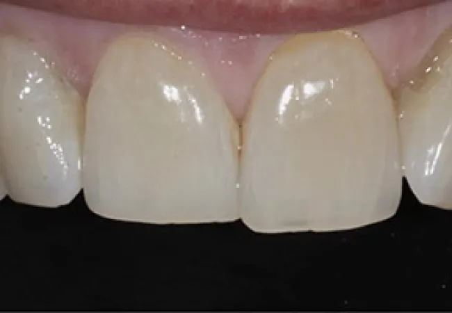 Close-up of upper front teeth showing slight discoloration and minor gap between central incisors