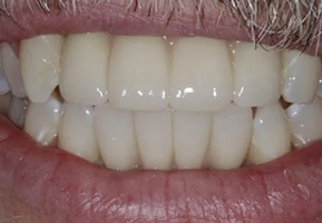 Close-up of a smiling mouth showing clean, white, well-aligned adult teeth and mustache hairs above.