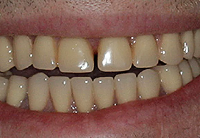 Close-up of a smile showing natural teeth with a slight gap between front teeth and mild discoloration.