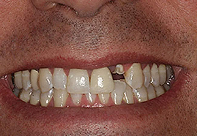 Close-up of a smile with missing upper front teeth and slight discoloration on natural teeth.