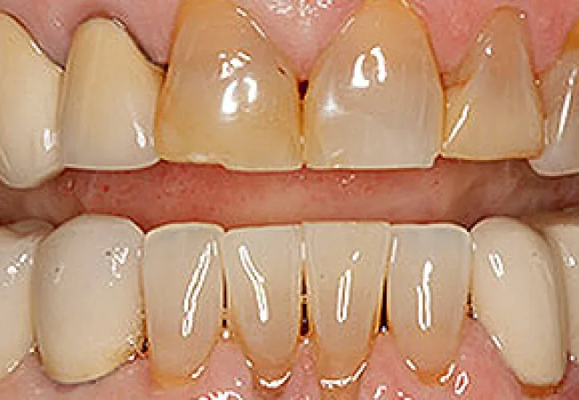 Close-up of upper and lower teeth showing discoloration, plaque buildup, and gum recession.