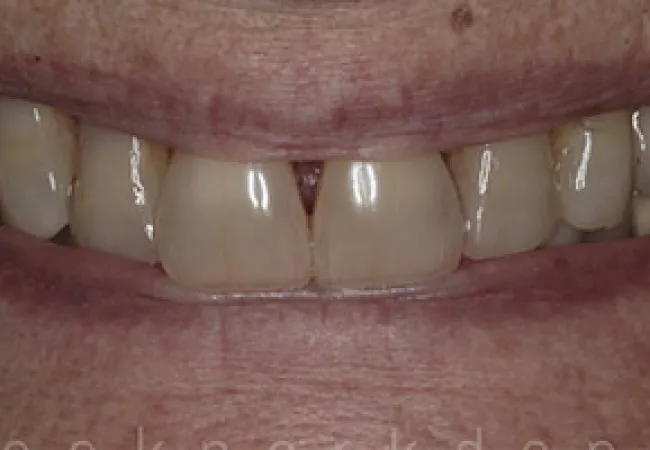 Close-up of a smile showing slightly discolored teeth with a gap between the two front teeth.