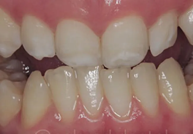Close-up of human teeth showing gaps and slight misalignment in the upper and lower front teeth.