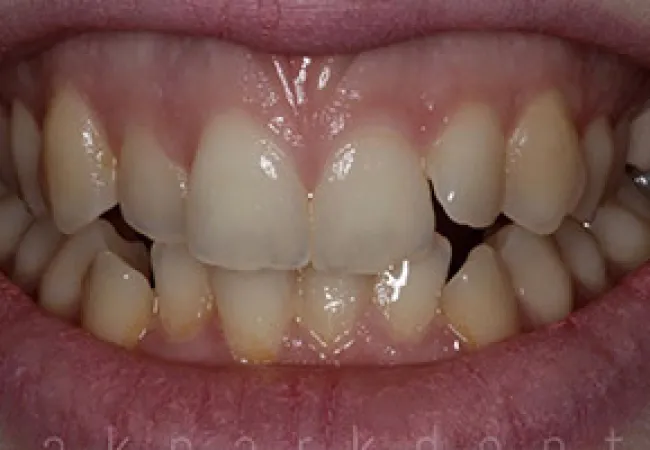 Close-up of uneven, crowded teeth with some discoloration and gaps on upper and lower jaws.