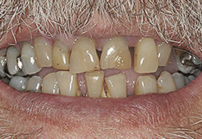 Close-up of a mouth with discolored, missing, and decayed teeth and metal dental work visible.