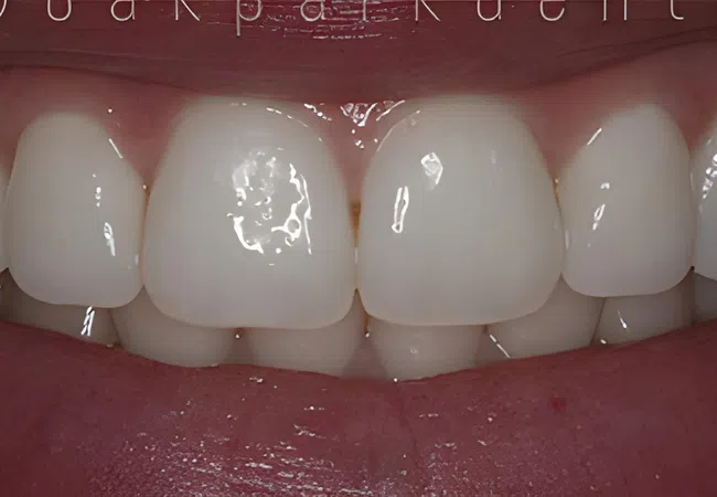 Close-up of a bright, clean smile showing upper and lower teeth with healthy gums and lips.