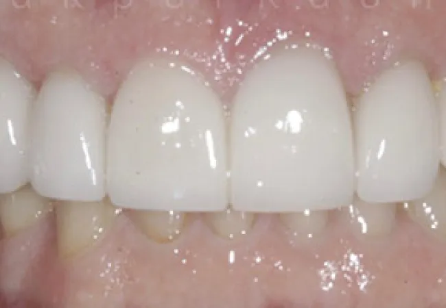 Close-up of upper front teeth with dental crowns and natural lower teeth visible on gums.