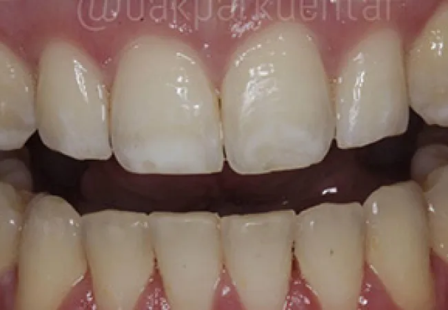 Close-up of human teeth showing mild discoloration and gaps between upper front teeth.