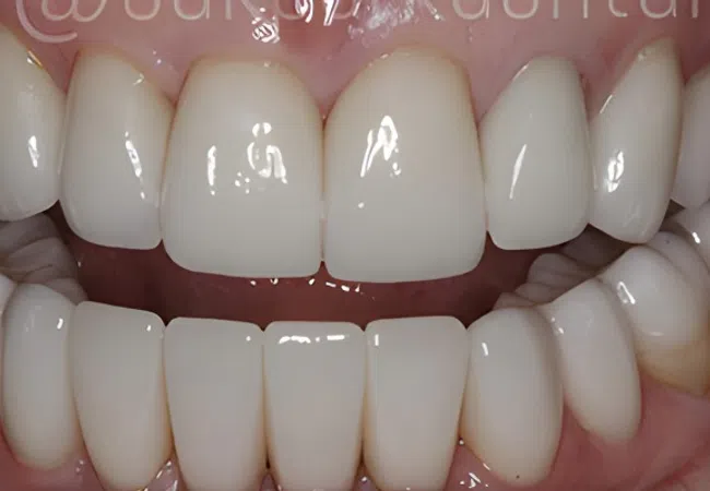 Close-up of a person's mouth showing clean, white, perfectly aligned teeth and healthy gums.
