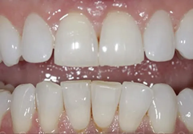 Close-up of upper and lower teeth showing dental alignment and natural tooth texture with gums visible.