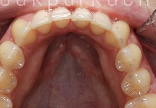 Close-up of upper teeth with a clear dental retainer on the front teeth, gums visible.