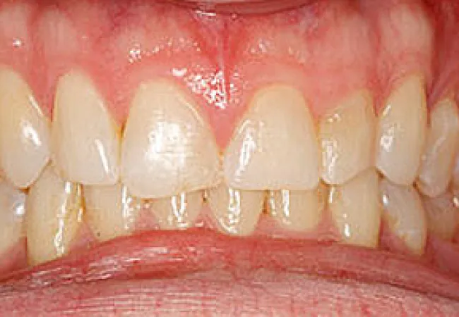 Close-up of human teeth showing mild plaque buildup and healthy gums in a natural mouth.