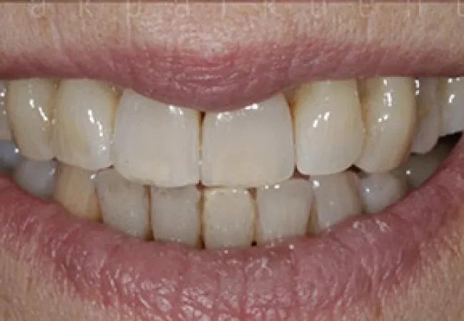 Close-up of a smiling mouth showing slightly yellowed and worn teeth with natural texture and lips.