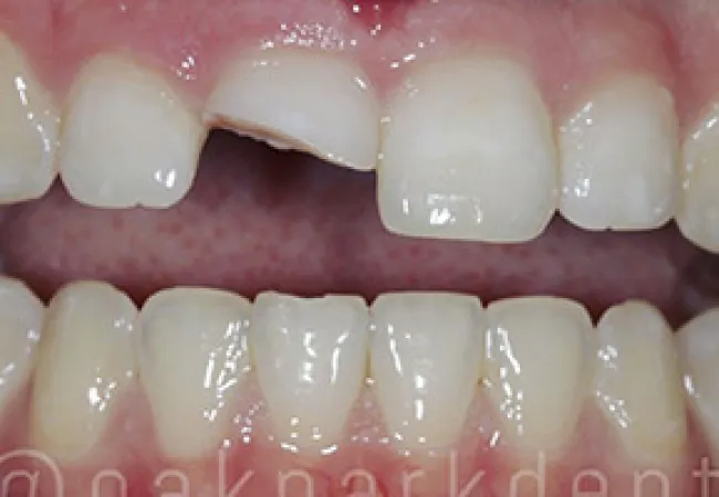 Close-up of upper front teeth with a chipped central incisor showing dental damage.