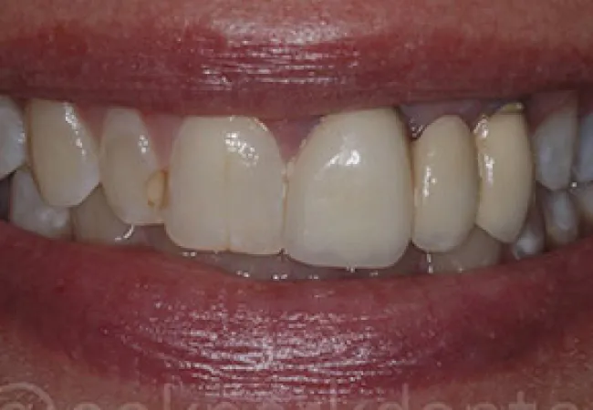Close-up of a smile showing natural teeth with some discoloration and dental work visible.